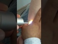 Download İzmir karşiyaka Dövme silme İzmir karşiyaka Dövme silme