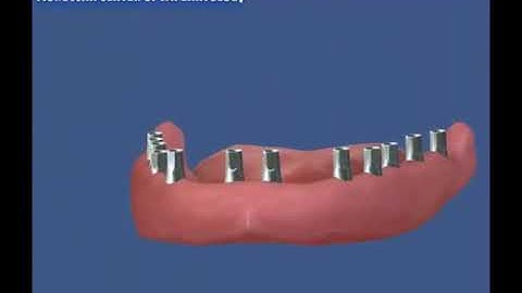 implantologie normale4