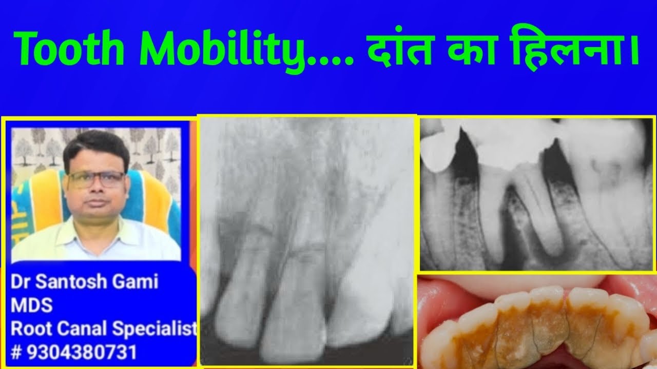 Tooth Mobility, It's Etiology, Prevention and Treatment.. - YouTube
