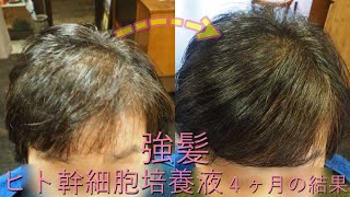 ヒト幹細胞培養液による強髪　４ヶ月の結果