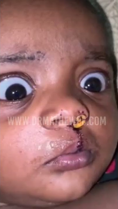 Baby's Appearance Changes After Cleft Lip Surgery In India | Dr Mathew PC #shorts