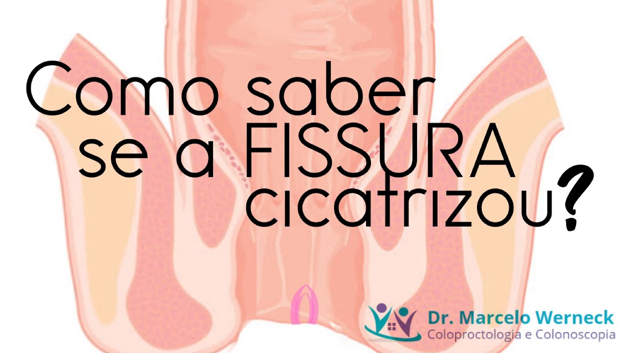 Como saber se fissura no ânus cicatrizou? YouTube Como saber se fissura no ânus cicatrizou? YouTube