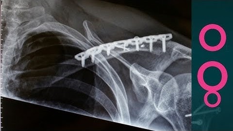 Glue for broken bones