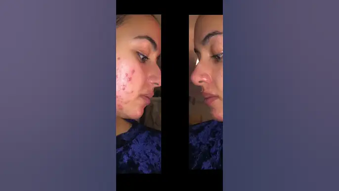 Outline Video My Experience With Doxycycline For Acne. #acneprone #hormonalacne