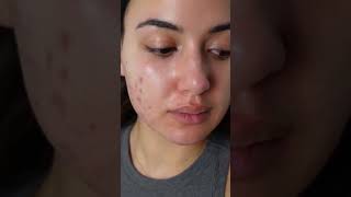 My Experience With Doxycycline For Acne. #acneprone #hormonalacne