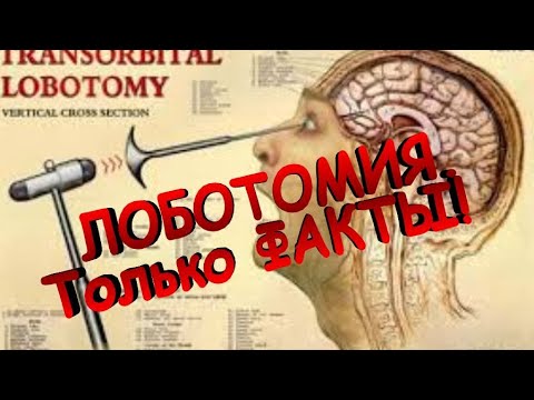 Что такое Лоботомия? Факты о Лоботомии.