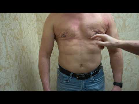 FIXING GYNECOMASTIA SCAR TISSUE @ 48 Hours POST-OP with NIPPLE REDUCTION SURGERY by Dr. Lebowitz