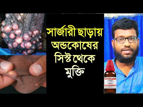 অন্ডকোষের গুটি সিস্ট এর হোমিও চিকিৎসা | scrotal sebaceous epidermal cyst homeopathy medicine