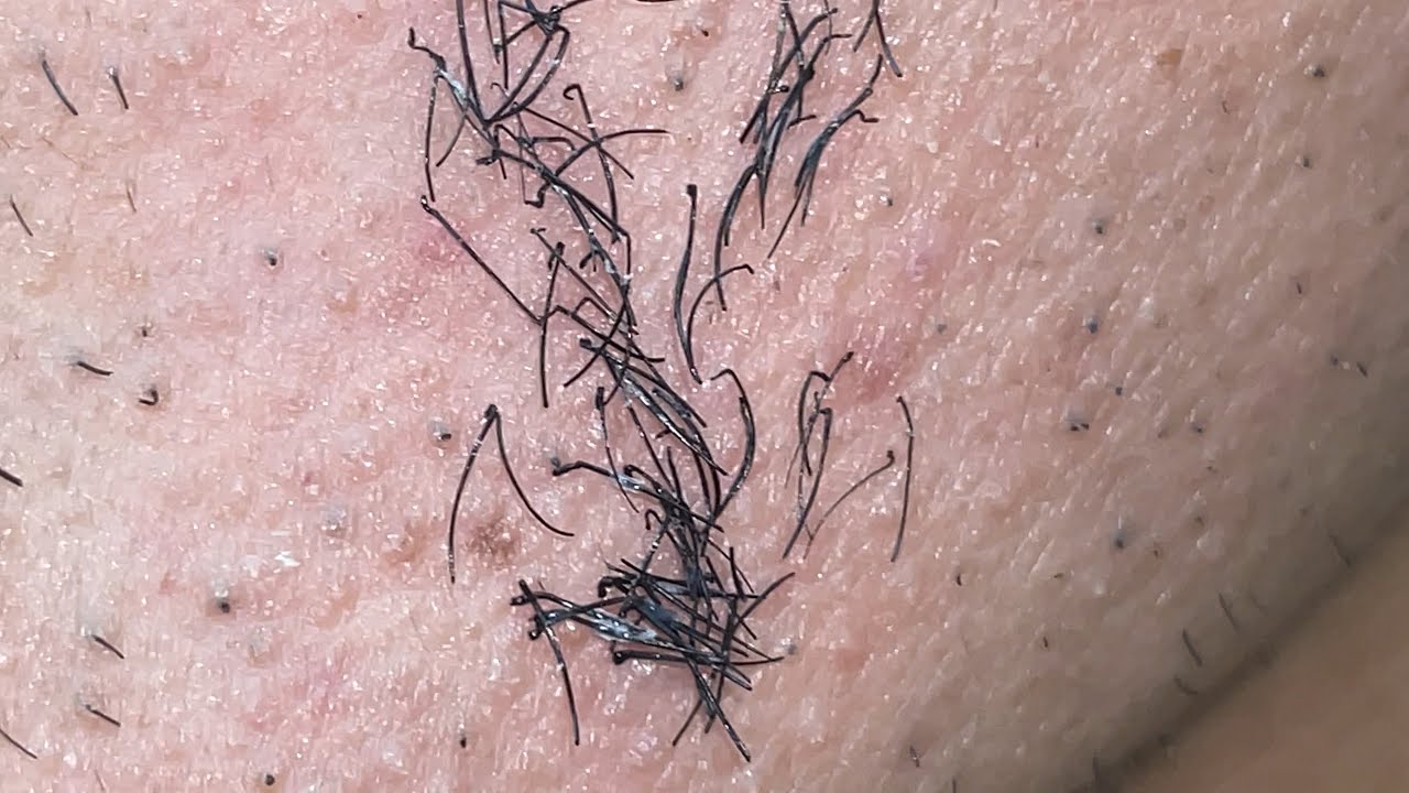 Plucking Facial Hair 386 YouTube