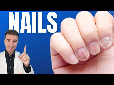 Видео: Какво е болестта на ноктите?