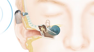 How the Cochlear™ Baha® Connect System works