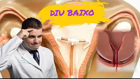 Quando o DIU de cobre está baixo?