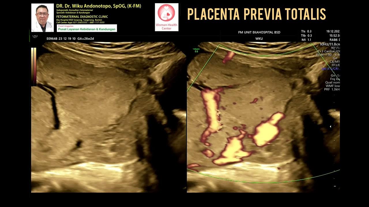 Placenta Previa totalis YouTube