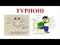 Typhoid || Enteric Fever || Cause, Symptom, Diagnosis, Treatment & Prevention of Typhoid