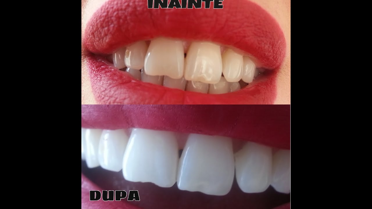 Denti Bianchi In 5 Minuti Rimedio Naturale Youtube