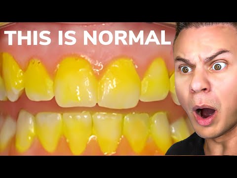 Can Whitening Toothpaste Cause Yellow Teeth