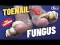 Cutting THICK Fungus TOENAILS Cutting THICK Fungus TOENAILS