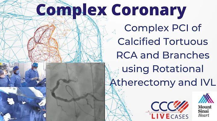 Complex PCI of Calcified Tortuous RCA and Branches using Rotational Atherectomy and IVL