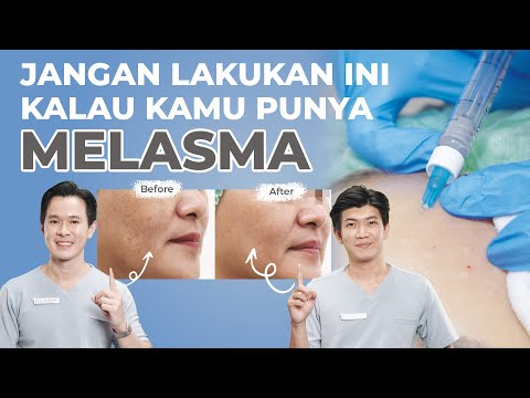 Video: Adakah anda perlu mengelupas melasma?