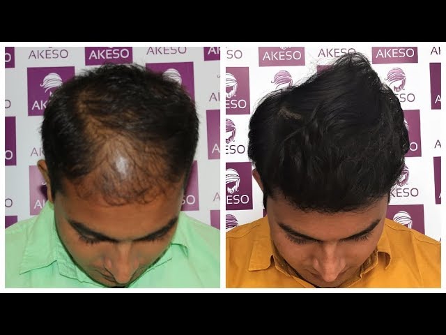 Akeso Hair Transplant Cosmetic  Plastic Surgery On call in Preet Vihar  Delhi  Book Appointment View Contact Number Feedbacks Address  Dr  Akhilesh Jangid