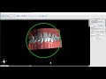 BSP 4.7 Ortho - Adding Brackets to Virtual Tooth Setup