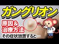 【医師監修】ガングリオンは指の付け根や手の甲に出来やすい。ガングリオンの原因と治療について解説