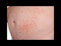 DERMATITIS EXFOLIATIVA ERITRODERMIA EXFOLIATIVA CAUSAS SÍNTOMAS TRATAMIENTO DATOS CLÍNICOS