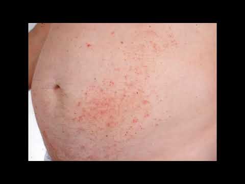 DERMATITIS EXFOLIATIVA ERITRODERMIA EXFOLIATIVA CAUSAS SÍNTOMAS TRATAMIENTO DATOS CLÍNICOS