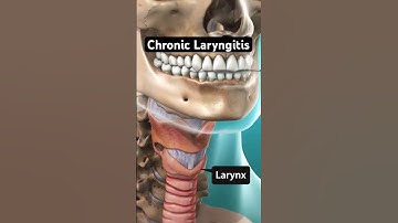 Chronic Laryngitis Explained (3D Animation)