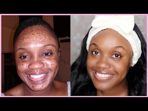 UPDATED AFFORDABLE SKIN CARE ROUTINE FOR ACNE, DARK MARKS, AND HYPERPIGMENTATION