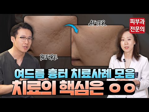 여드름 흉터 없애는 가장 효과적인 방법 (feat. 실제 치료 사례 모음)