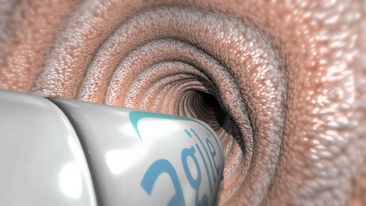 Система Agile patency: подтверждена проходимость желудочно-кишечного тракта
