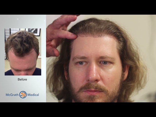 Hair Transplant Blogger Video Update