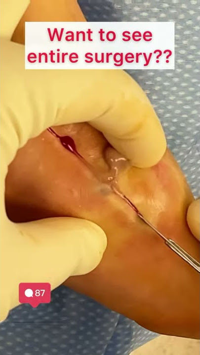 Draining pus from foot infection | #shorts