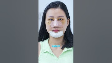 Quyết tâm thay đổi với combo nâng mũi + độn cằm + cấy mỡ mi mắt