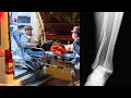 TAKUYA ISHIZUKA スケボー人生は終わったと思った。