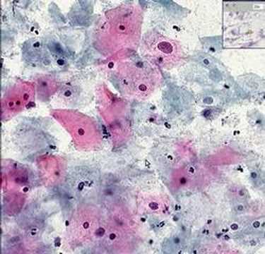 Histopathology Cervix--High grade squamous intraepithelial l