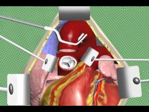 Aortic Valve Replacement Surgery Animation by Cal Shipley MD