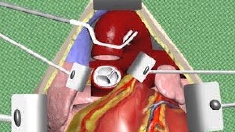 Aortic Valve Replacement Surgery Animation by Cal Shipley, M.D.