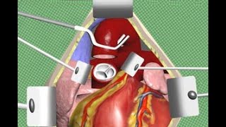 Aortic Valve Replacement Surgery Animation by Cal Shipley, M.D. screenshot 4