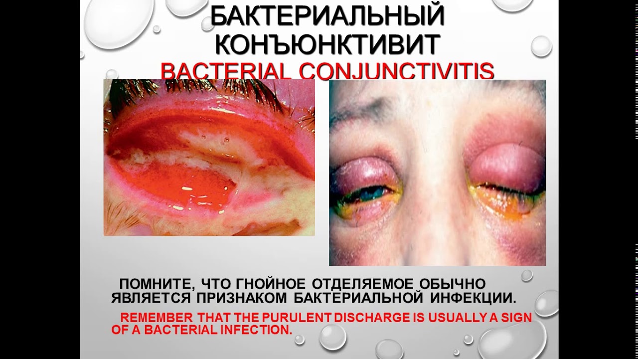 Воспалительные заболевания глаз