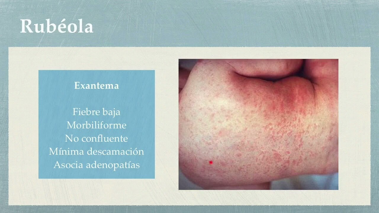 Enfermedades exantemáticas en pediatría