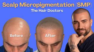 Importance of Scalp Micropigmentation (SMP) for Hair Loss