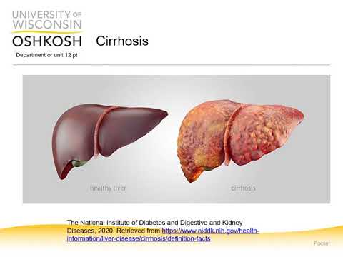 Cirrhosis, Portal Hypertension, and Ascites