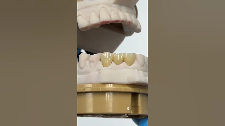 Anterior Zirconia Pontic Bridge #lsk121shorts #dentist #teeth