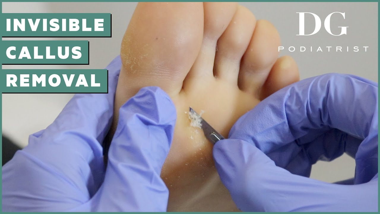 👣 Pedicure Tutorial Callus Removal on Ball of Foot and Foot