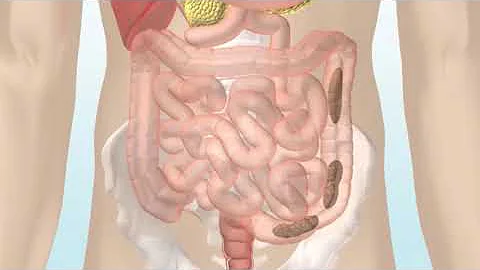 ¿Cuál es la causa de la bolsa abdominal inferior?