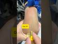 How to Insert a 24G Yellow IV Cannula Perfectly! | Day 67 Clinical Skills#shortvideo #shorts #safi