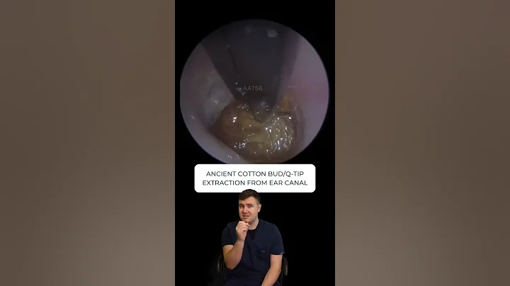 ANCIENT COTTON BUD/Q-TIP REMOVAL FROM EAR CANAL - ...