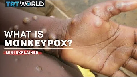 What is monkeypox? - DayDayNews